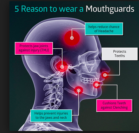 5 Reasons to wear a Mouthguard