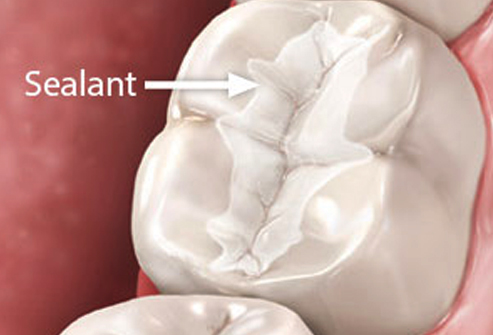 Dental Sealants