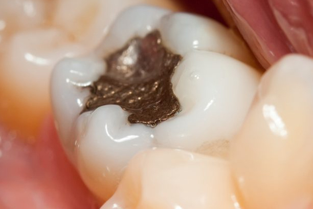 Fillings Image 1