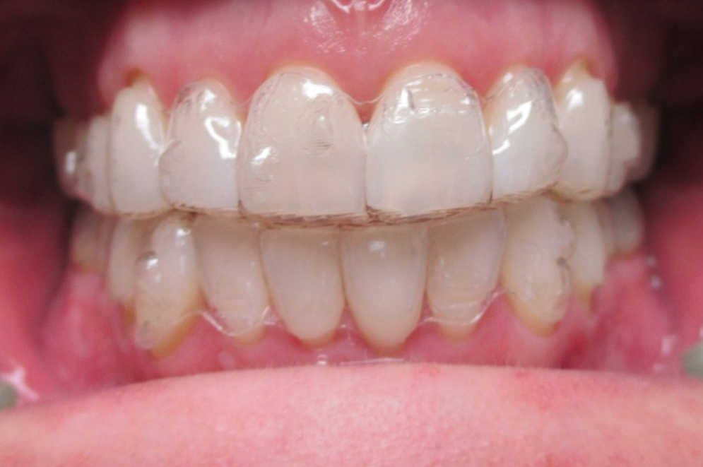 Invisalign Post 3